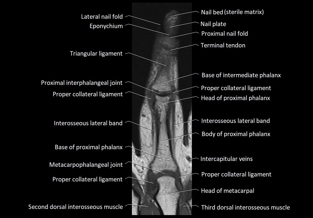 Finger anatomy coronal cross section 3TMRI labelled  image 4.webp